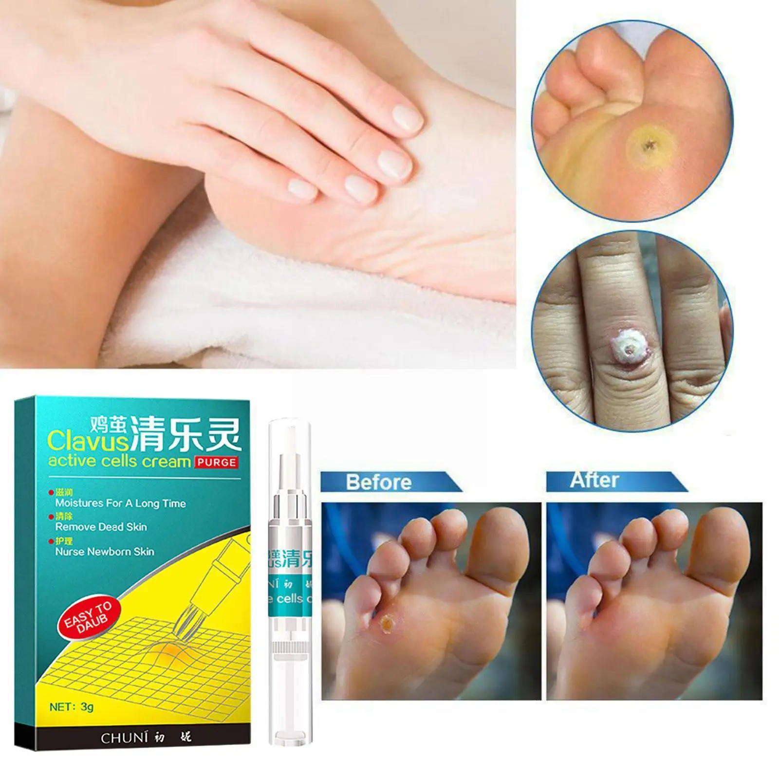 

Chinese Medicine Treatment Skin Warts Removal Foot Plantar Warts Medical De Corn Pomada Skin Ointment Care Verruga Removal E9o4