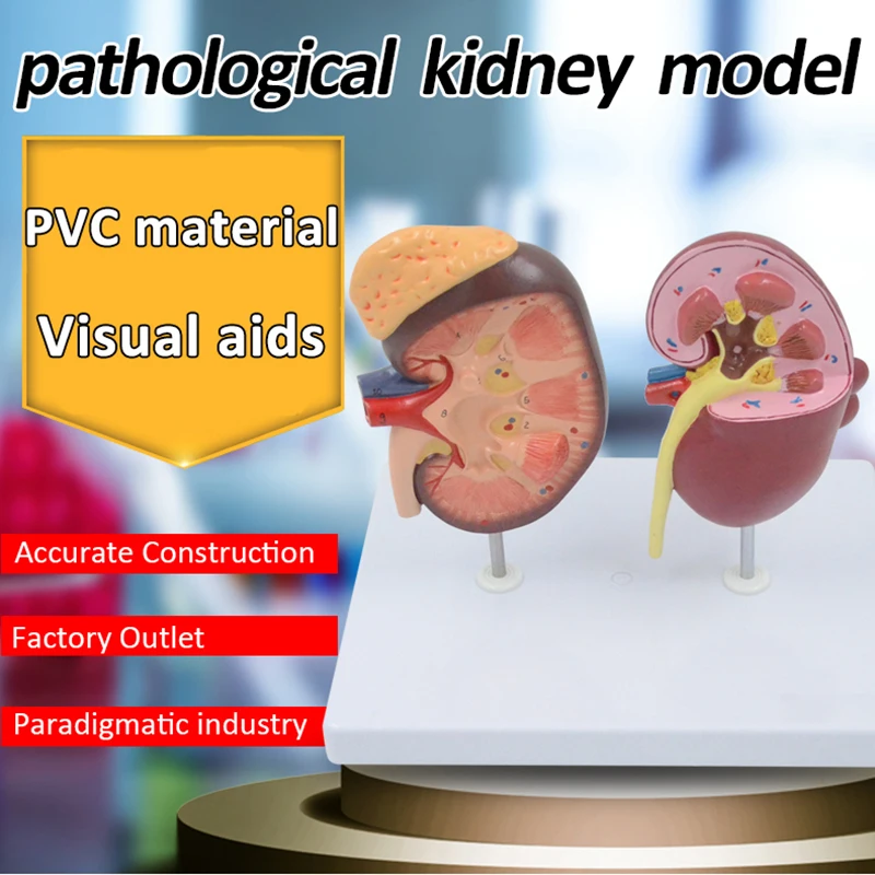 Normal and Diseased Kidney Model Urinary System Renal Anatomy Model