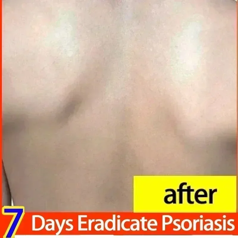 Самый эффективный здоровый дневной крем натуральный травяной антибактериальный