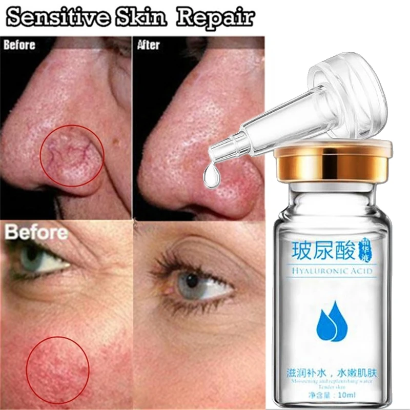 

Hyaluronic Acid 10ml Anti Spider Vein Oil Facial Redness Removal Redness Repair Essential Oil Sensitive Skin Facial Treatment
