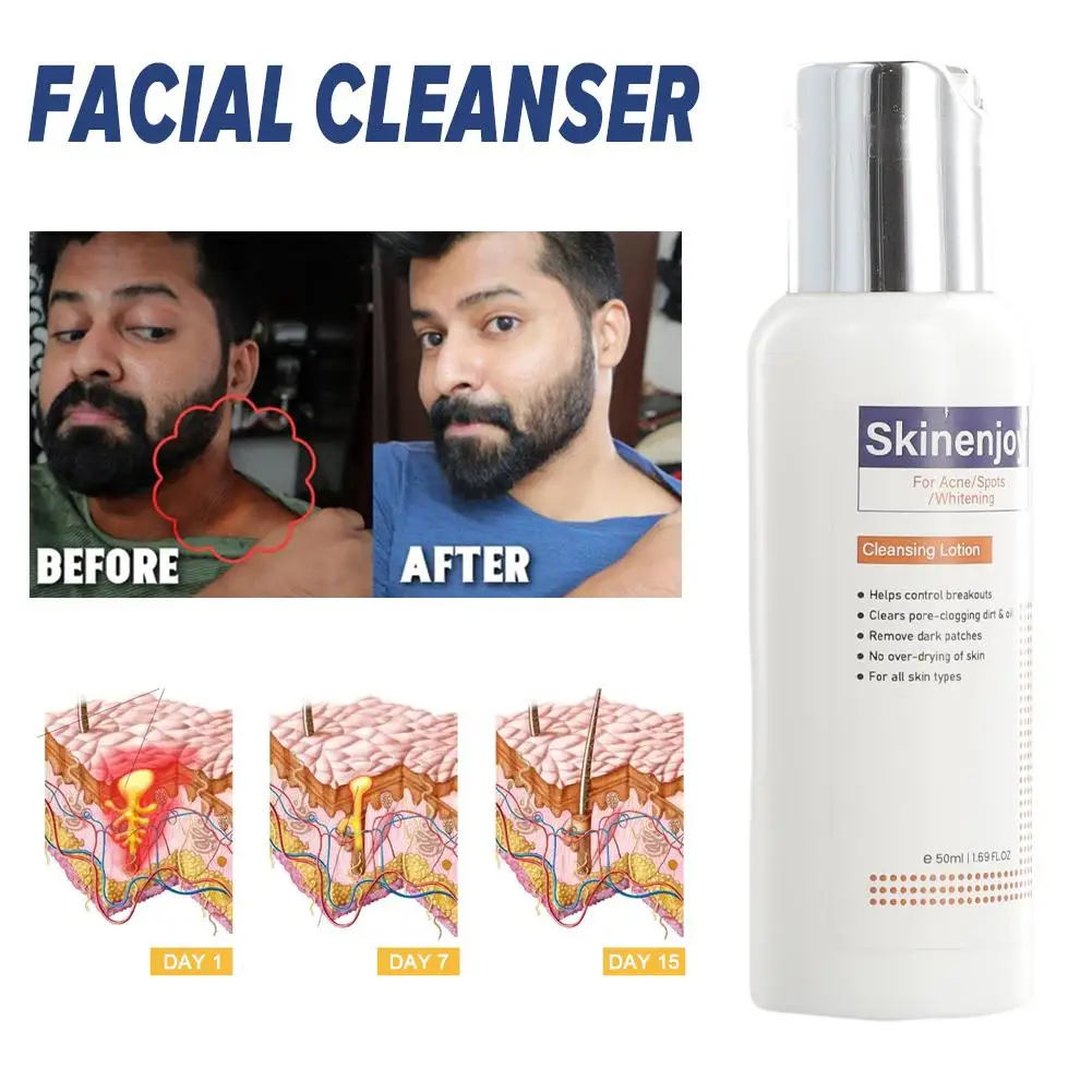 

Acanthosis Nigricans Skin Cleanser Deep Clean Soft Facial Repair Darkening Cleansing Moist Skin Lightening Brightening Skin N3S2