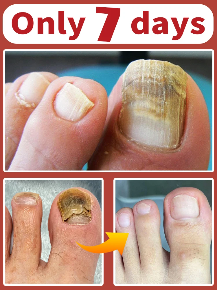 Растворите проблемы с ногтями