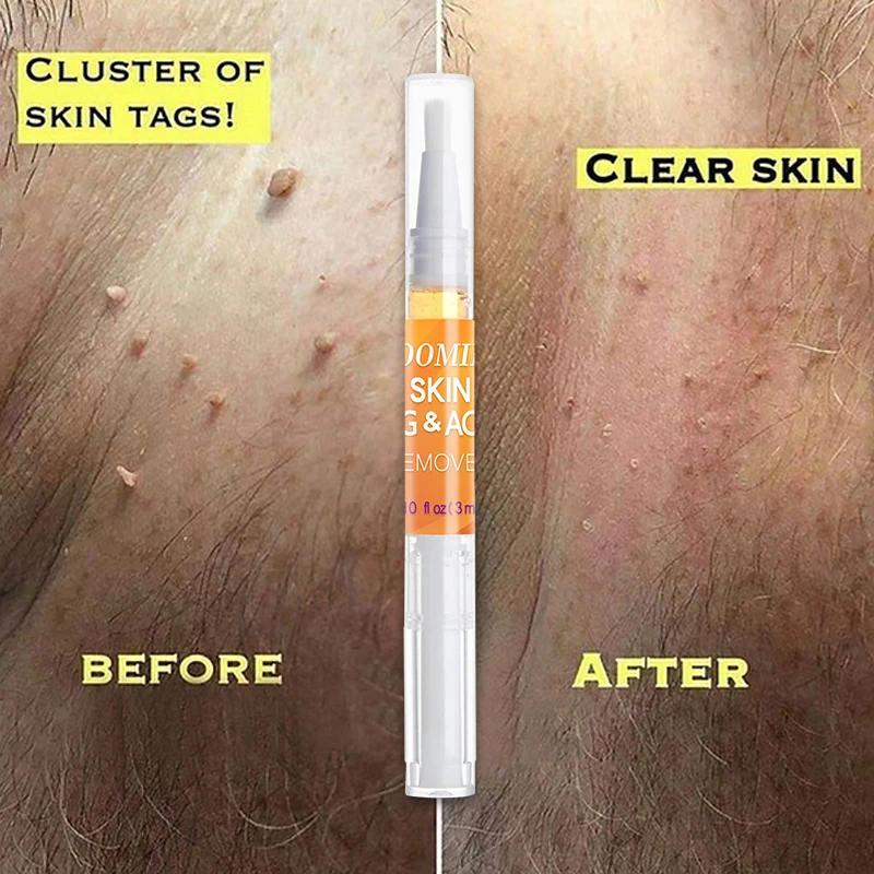 Флуоресцентная ручка для удаления бородавок с кожей жидкая лечения папилломы 1