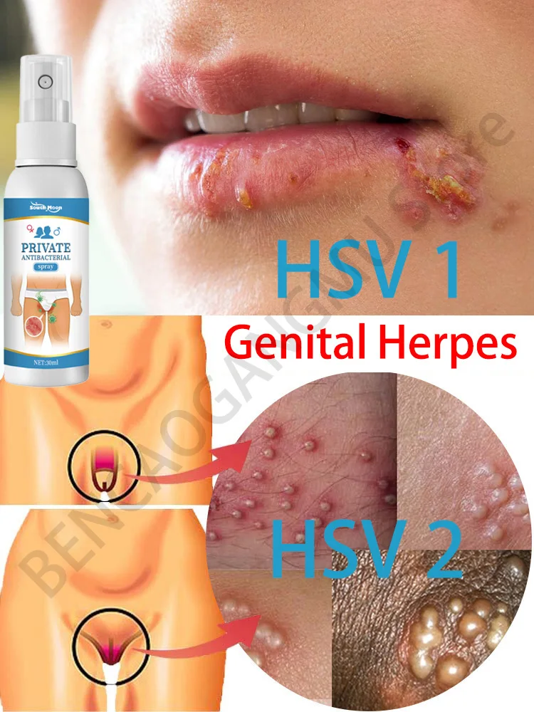 

Anti Herpes Killer Remove Genital Herpes Cream Treatment Men Women Herpes On The Lips Skin