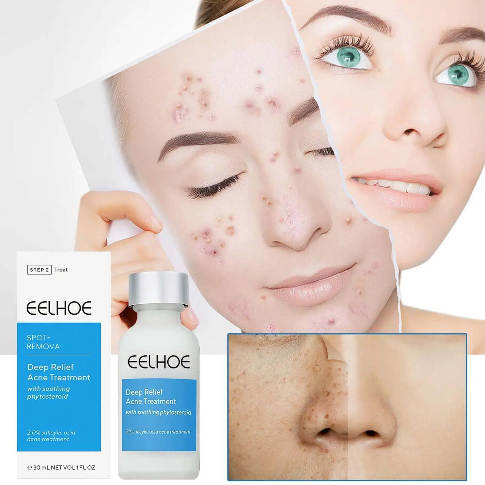 

Эффективное средство для лечения акне, сушильный лосьон, 30 мл, сыворотка для лечения акне, глубокое облегчение ухода за кожей, Ранняя Сыворо...