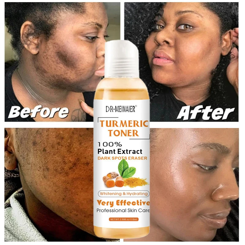 

Turmeric Serum Blemish Dark Spots Corrector Turmeric Toner Face Whitening Moisturizing Vitamin C Ginger Toner Facial Acne Remove