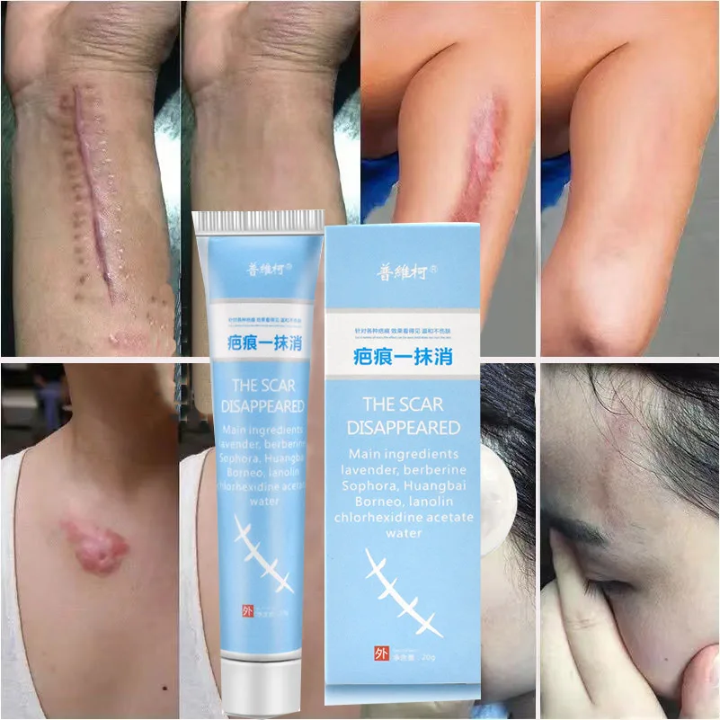 

Herbal Essence Skin Scar Removal Cream For Burns Surgery Plastic Hyperplasia Acne Marks Stretch Marks Pigment Remove Scar Cream