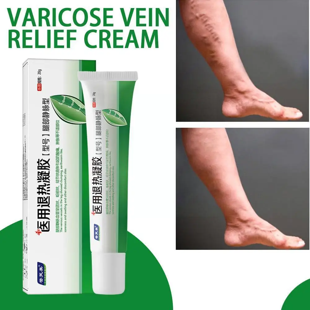 

Sdotter 20g Varicose Vein Relief Cream Leg Vasculitis Phlebitis Removal Pain Skin Vein Ointment Leg Shape Relief Spider Care Ang