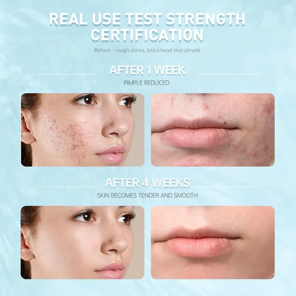 

15ml Salicylic Acne Repair Lotion Salicylic Acid Pore Skin Acne Refining Pore Refining Cream Cream Care Repairing Refreshin G2U7