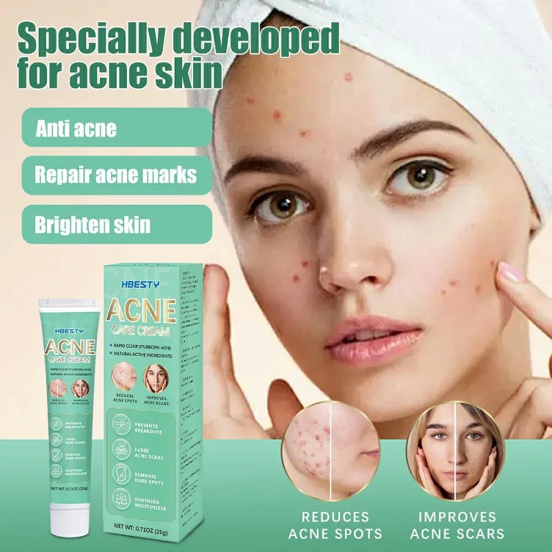 

Herbal Acne Cream Anti Acnes Treatment Pimples Marks Remover Repair Scars Whitening Dark Spots Blemish Oil Control Face Cream