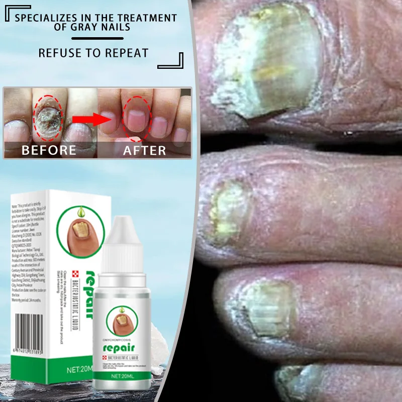 

Сыворотка для лечения грибка ногтей, 20 мл