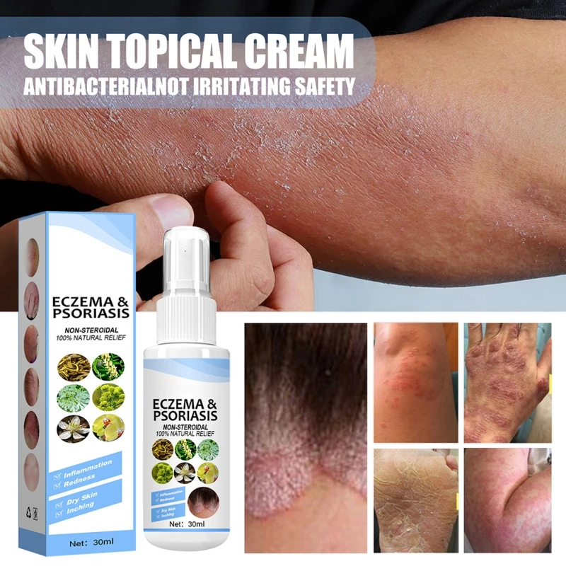 

Skin Psoriasis Spray Herb Essence Dermatitis Eczematoid Eczema Ointment Treatment Psoriasis Skin Care Antibacterial Spray 30ml
