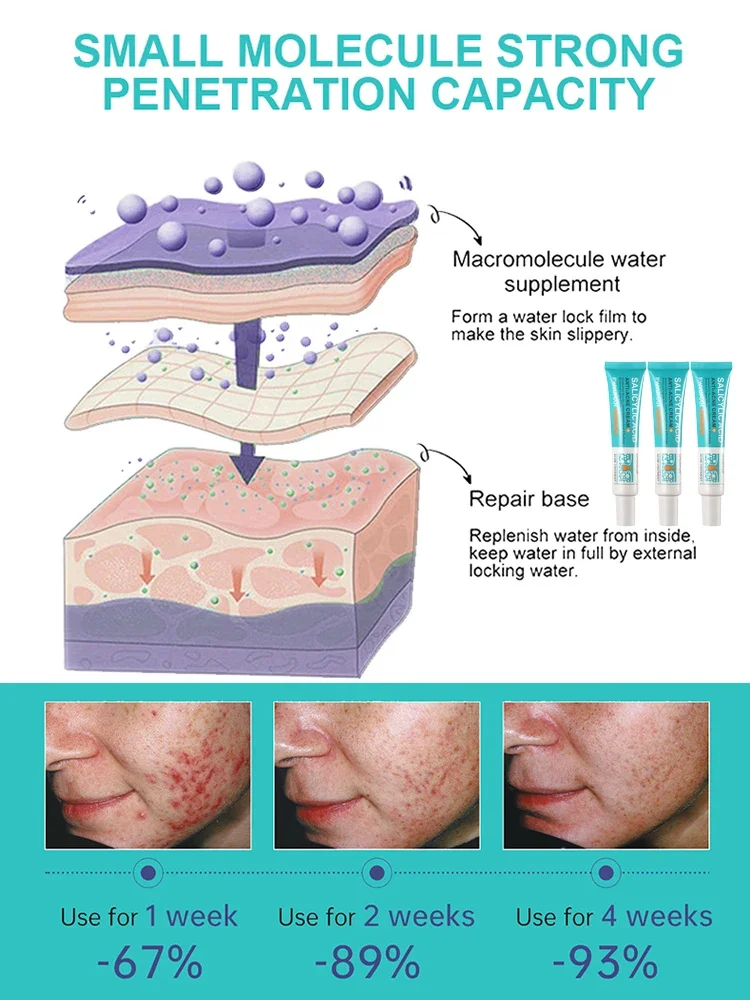 Салициловая кислота крем для лечения прыщей гель восстановления против