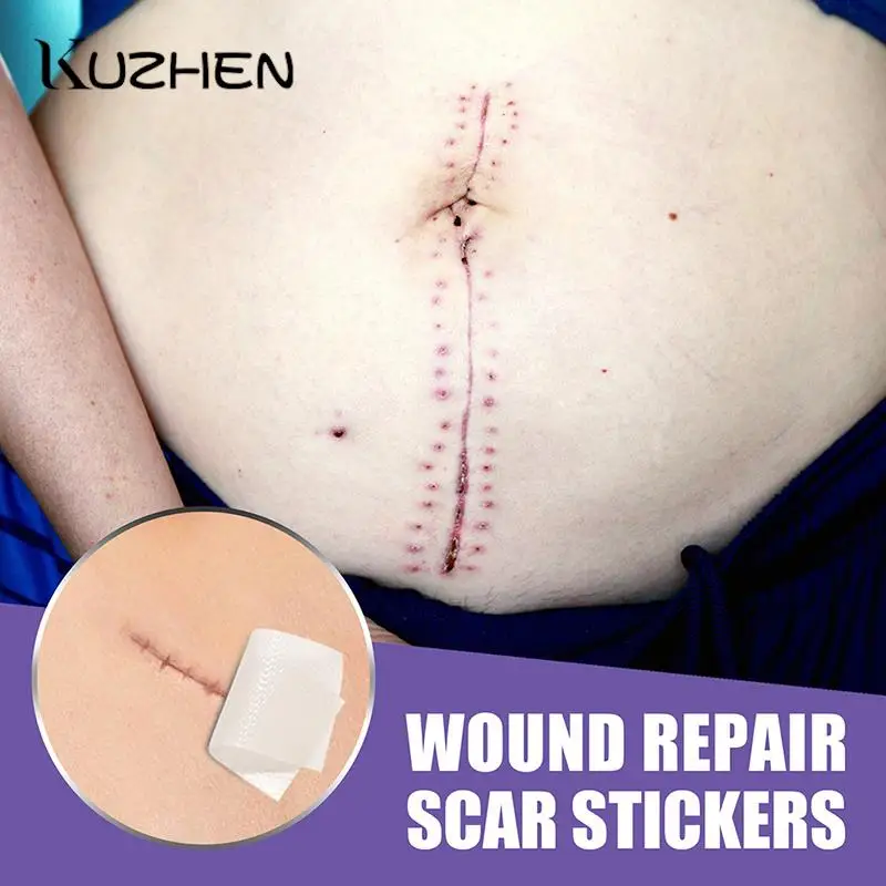 

Шрамы для удаления рубцов, силиконовый гель, искусственная кожа, нашивка лента для лечения акне, сгорание, уменьшение существующих шрамов, п...