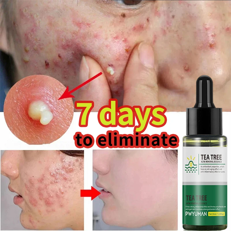 

Tea Tree Anti Acne Face Serum Removal Acne Marks Pimples Repair Essence Oil Control Shrink Pores Whitening Skin Korean Cosmetics