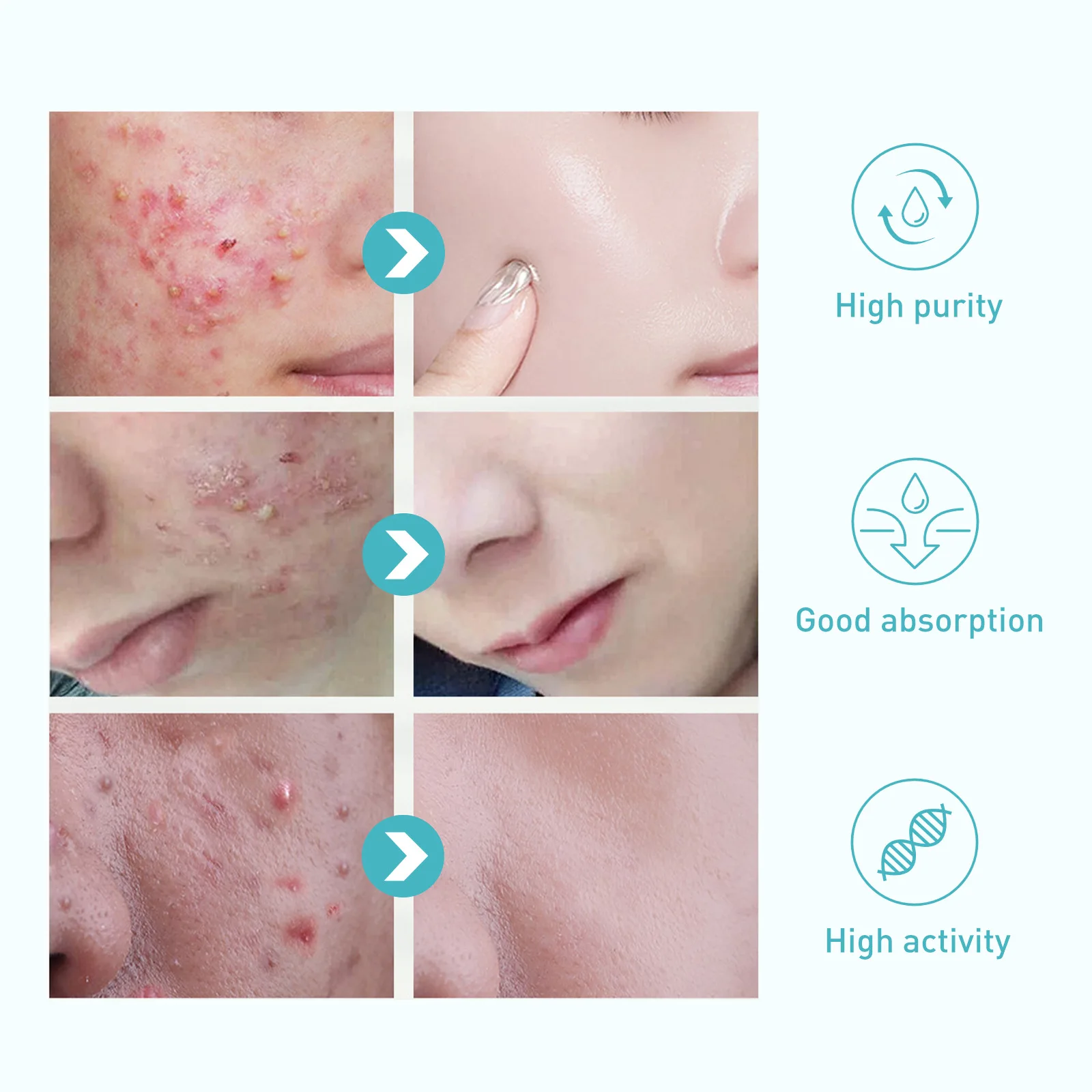 Травяной крем для удаления прыщей уход за кожей лечение традиционной китайской