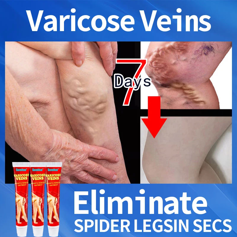 

Эффективный крем для облегчения варикозного расширения вен мазь для устранения варикозного расширения вен лечение боли