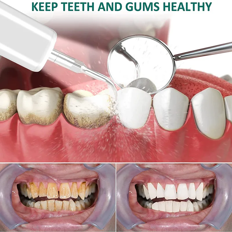 Ультразвуковой стоматологический скалер для зубов Электрический клетчатый