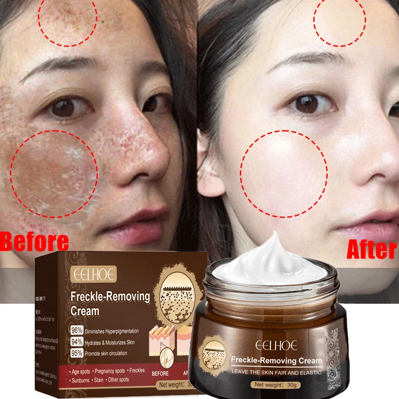 

Freckle Whitening Cream Remove Melasma Dark Spot Lightening Melanin Face Moisturizing Anti-Aging Firming Skin Care Cream Product