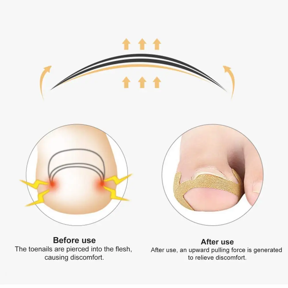 

1 Set Toe Corrector Stickers Breathable Nail Care Manicure Ingrown Toe Nail Correction Patch Foot Care