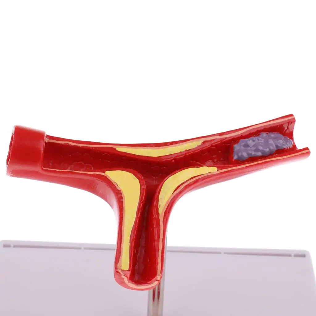 Увеличение 50x -секция человеческого сосуда Атеросклероз Тромб Сосудистый