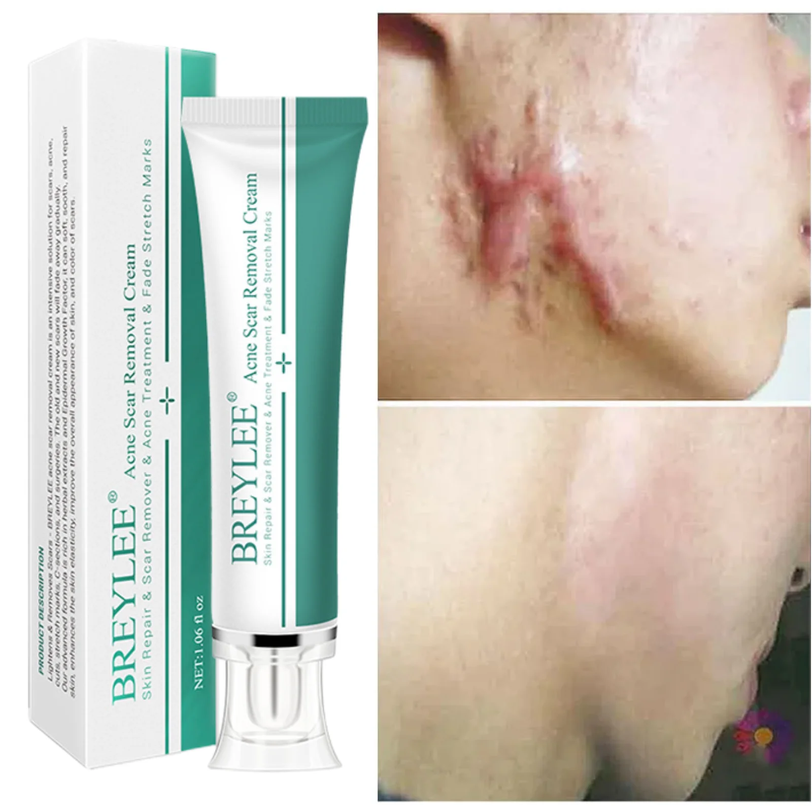 

Herbal Scar Removal Cream Gel Remove Acne Spots Fade Stretch Marks Burn Surgical Scars Repair Smoothing Whitening Body Skin Care