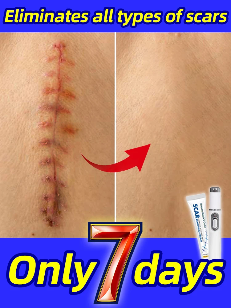 Crème pour цикatriices pratiqueloïdes thupanpie или лазер.