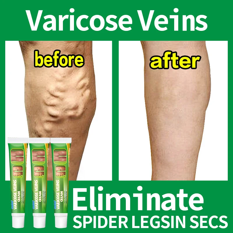 

Effective Varicose Vein Relief Cream Ointment For Varicose Veins To Relieve Vasculitis Phlebitis Spider Pain Relief