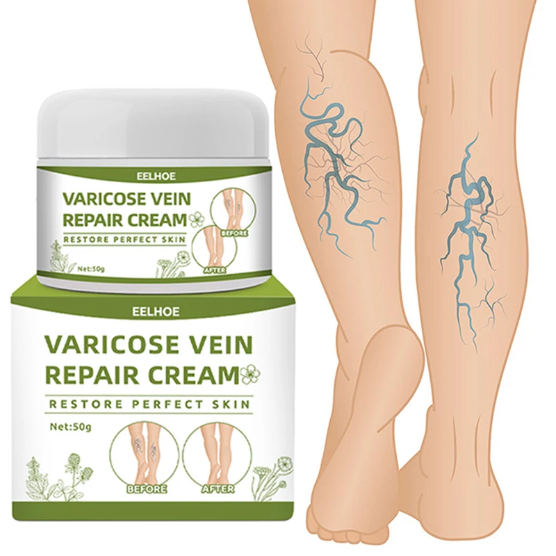 

Varicose Vein Cream Swelling Earthworm Leg Care Vasculitis Phlebitis Spider Pain Relief Ointment Medical Plaster Relief Cream