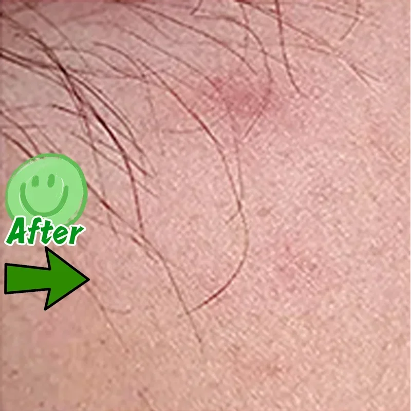 Морской невус на голове бородавки кожу головы обезьяне каулифтовая ручка