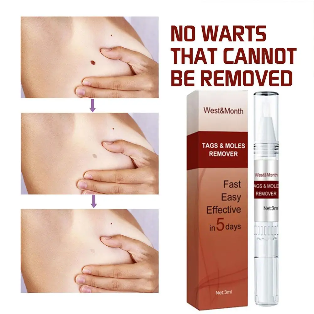 Рисунок 2 - жидкая ручка для удаления мозолей и бородавок