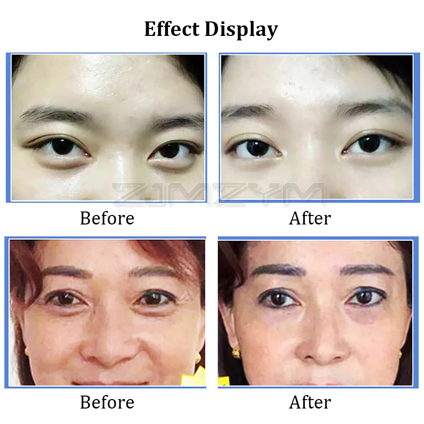 Портативный ультразвуковой кислородный косметический аппарат для ухода за