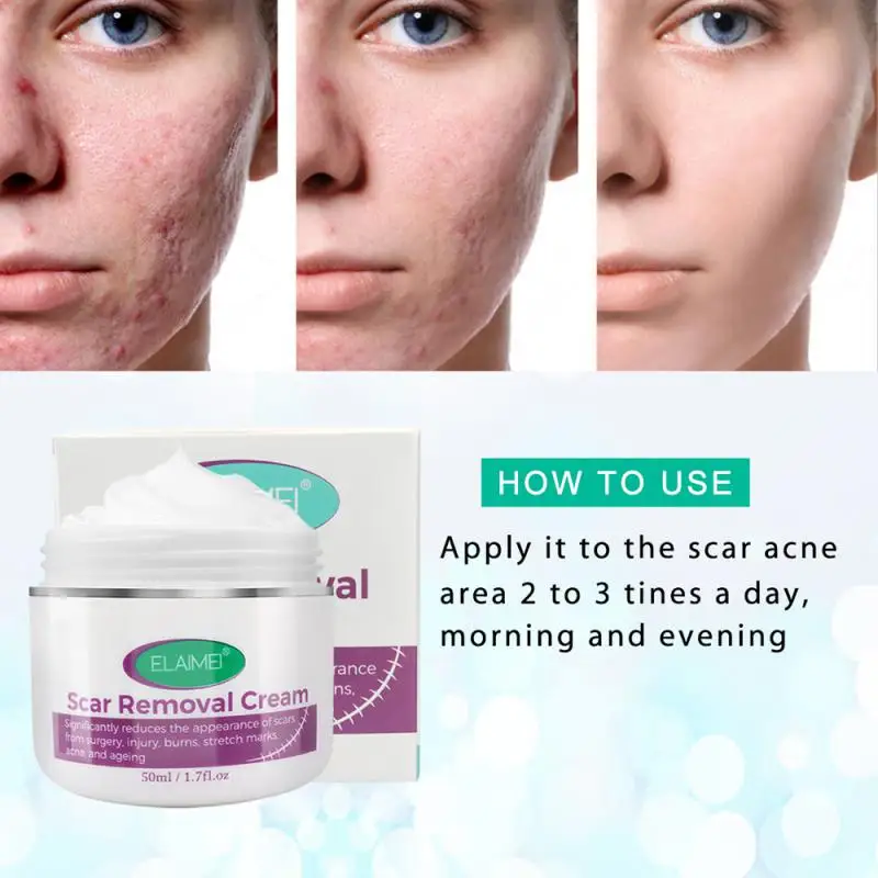 

Burns Scar Removal Natural Enhancing Effective Stretch Mark Removal Breakthrough Natural Scar For Postpartum Recovery