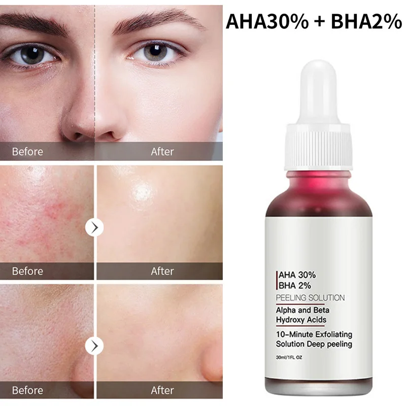 

Facial Serum AHA 30% + BHA 2% Peeling Solutions Anti Acne Serum Facial Exfoliator Peel for Dark Spot Shrink Pore Reduce Wrinkle