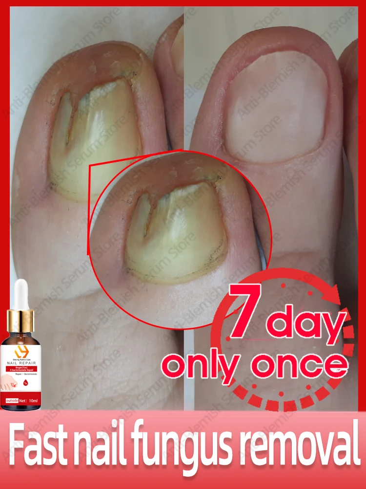 

Nail Fungal Treatment Serum Onychomycosis Paronychia Anti Infection Toe Fungus Hand