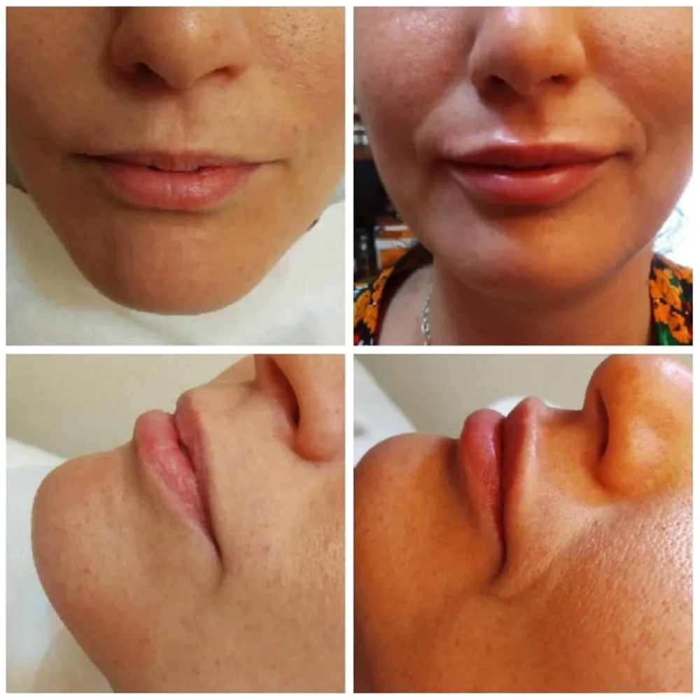 

Korean Lip Hyaluronic Acid Crosslinked HA Enhancement Makeup Whitening Cosmetic Anti-wrinkle Moisturizing for Hyaluron Pen