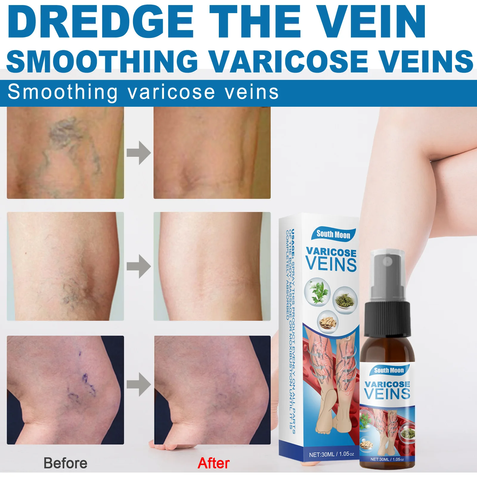 

30ml leg body care varicose vein spray vasculitis phlebitis spider leg smooth vasculocele treatment redness herbs