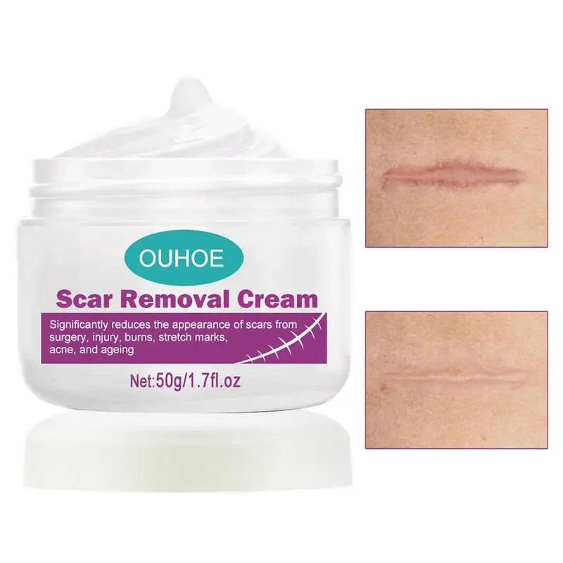 

Крем для удаления шрамов, старый и Новый бальзам для восстановления шрамов, лечение шрамов, хирургические рубцы, C-образные разрезы и ожоги, ...