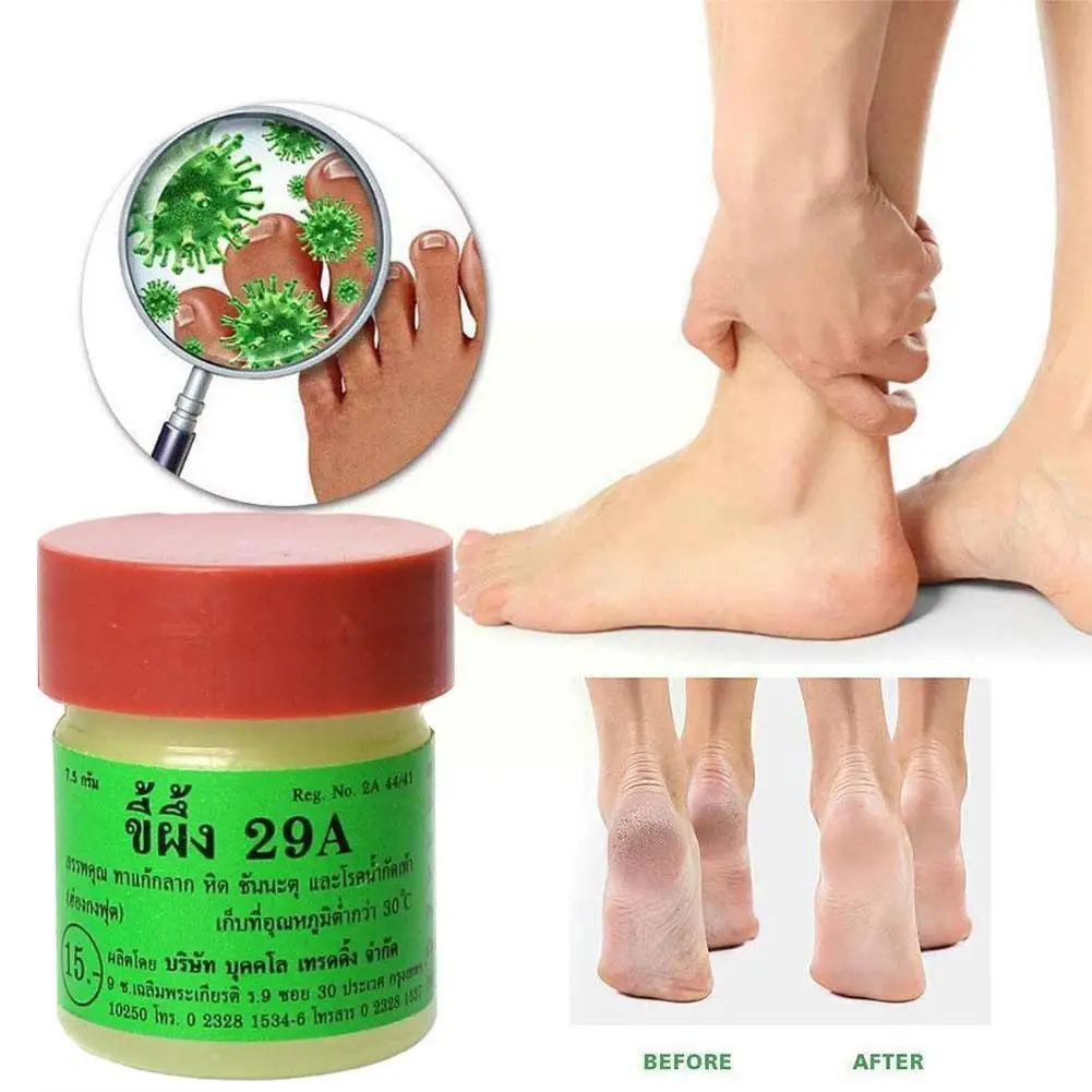 

Dermatitis Psoriasis Eczma Pruritus Cream Foot Care Treatment Athletes Scabies Tinea Fungal Ointment Foot Cream Anti Ringwo O9D2