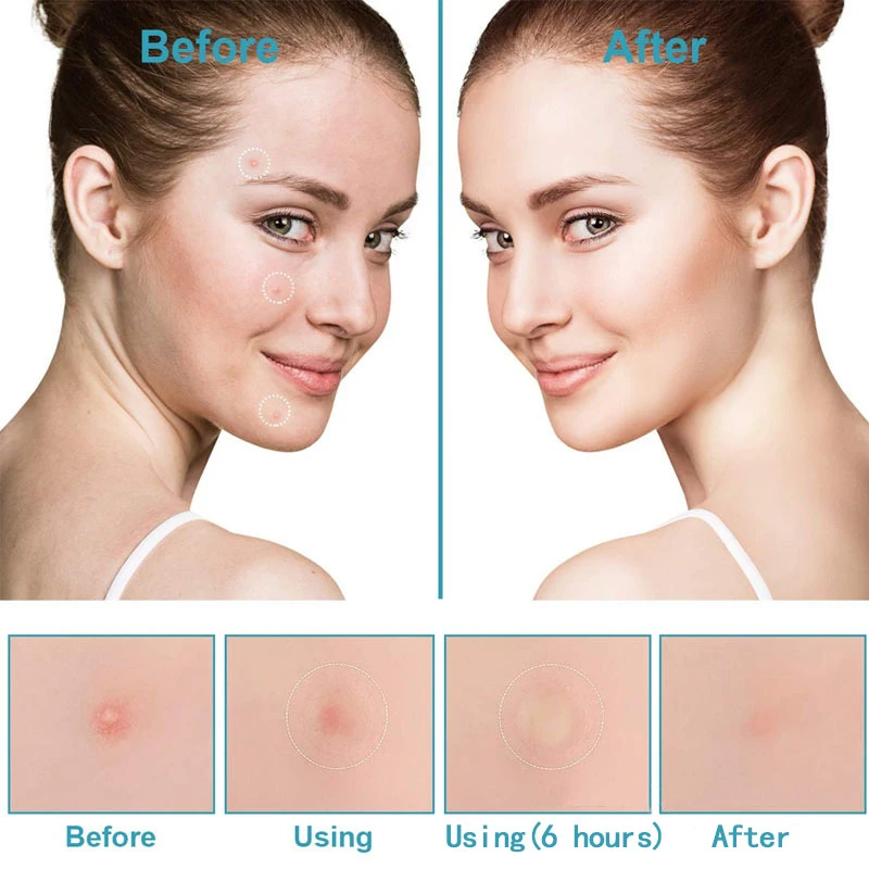 360 шт. невидимые пластыри от прыщей гидроколлоидные против пятна следы консилер