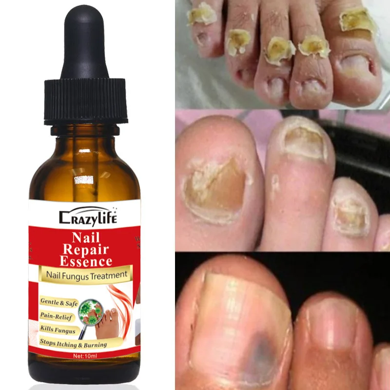 

Sdotter Nail Fungal Treatment Essence Serum Care Hand Foot Care Anti Infection Paronychia Onychomycosis Foot Toe Nail Fungus Rem