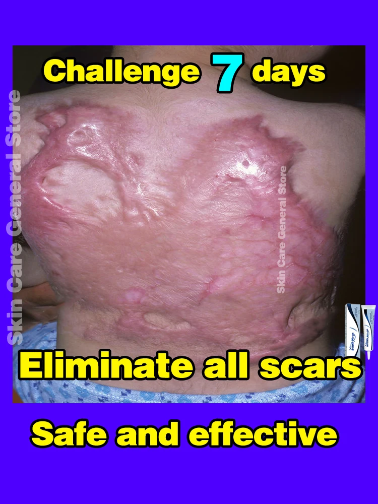 

Scar Removal Cream Old Scar Cream Effective Repair New Scars Surgical Scars Stretch Marks Acne Pits Acne Marks Burn Scars