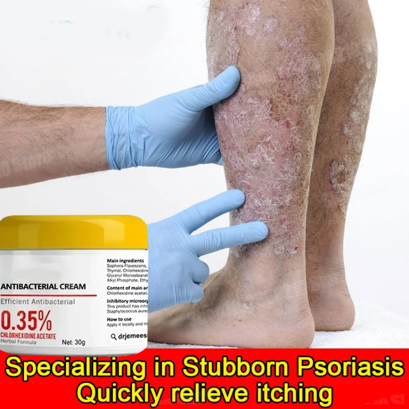 Мазь от псориаза идеально подходящая для проблем на коже крем противозудный