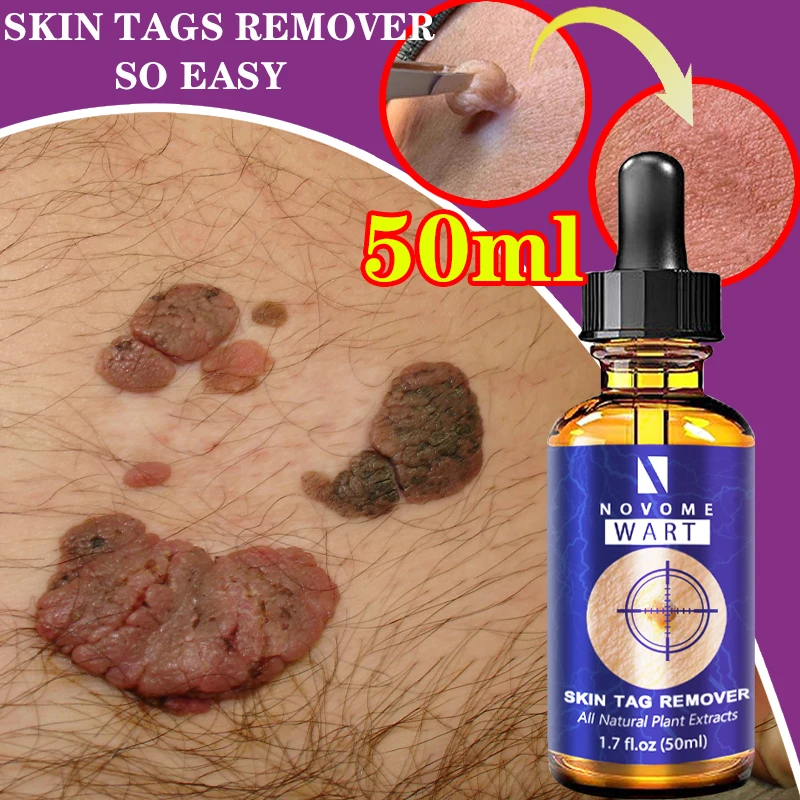 

New Removing Against Moles Remover Anti Verruca Remedy Liquid Pen Treatment Papillomas Removal of Warts Liquid From Skin Tags