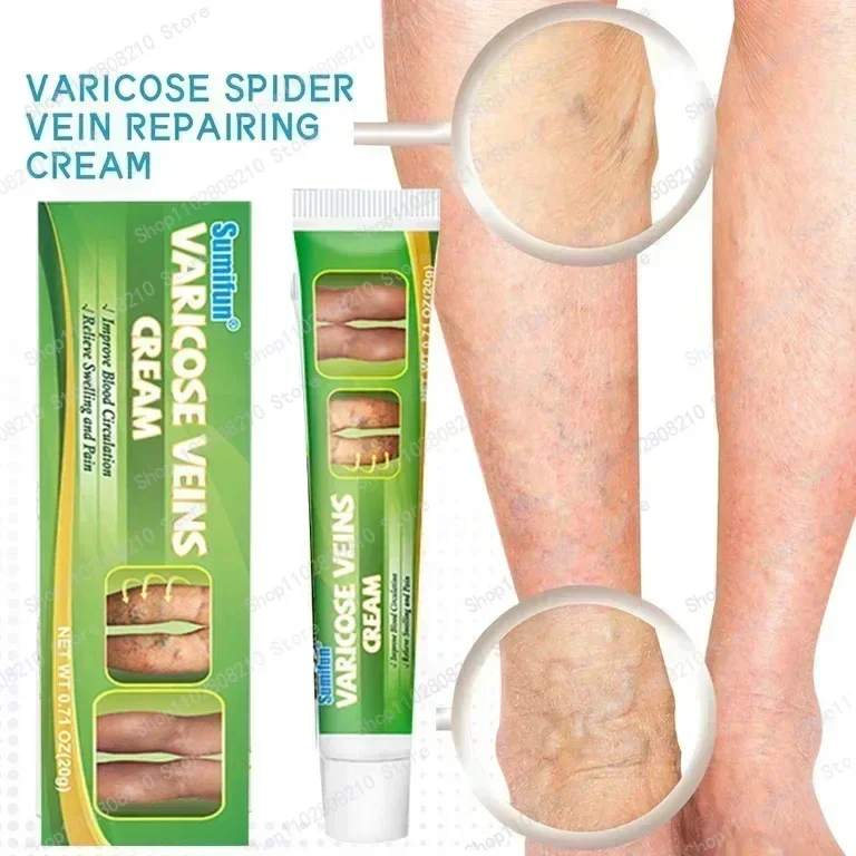 Оригинальное средство для снятия варикозного расширения вен