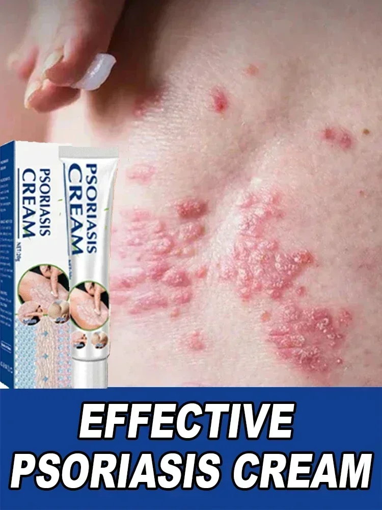 Лучший продукт против дерматита при псориазе и экземе: натуральный растительный