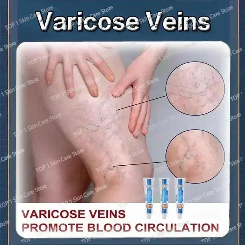 Восстанавливающий крем от варикозного расширения вен Tongmai эффективное