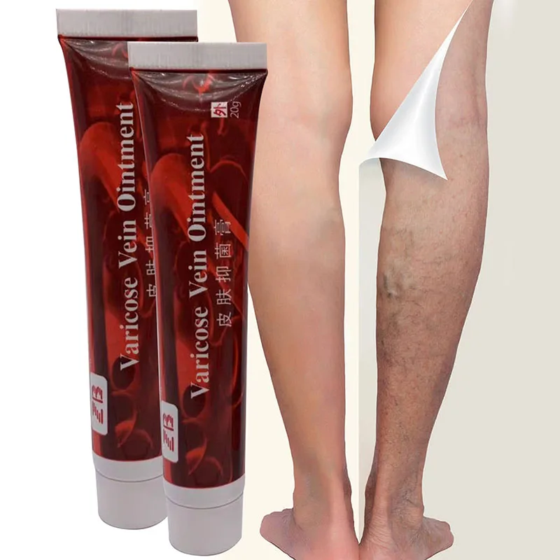 

Varicose Veins Ointment Treatment Vasculitis Phlebitis Angiitis Inflammation Blood Vessel Rotten Legs Varicose Veins Cream