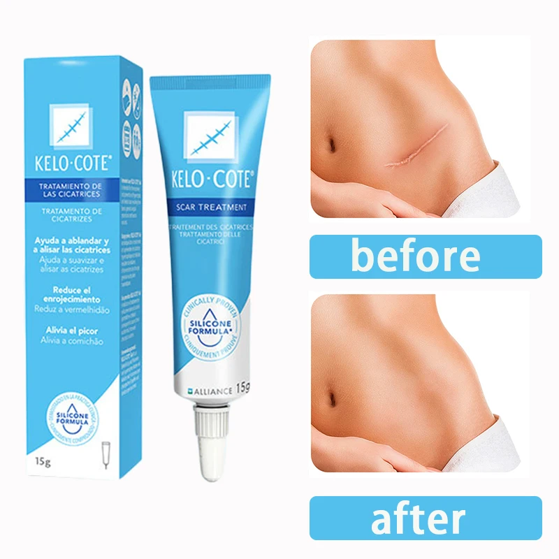 Kelo-cote/ Barker SScar Removal Cream Pimples Stretch Marks Scar Gel Smoothing Body Skin Care Promote Cell Regeneration