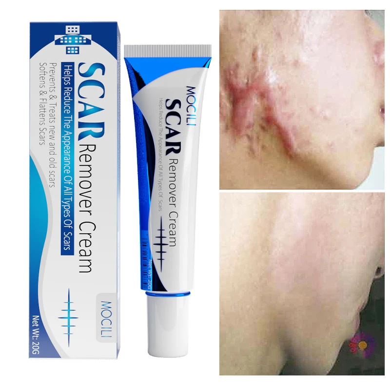

Scar Removal Cream Repair Mark Burn Surgery Ginger Root Oil Scar Treatment Acne Scar Stretch Marks Smooth Moisturizing Body Care